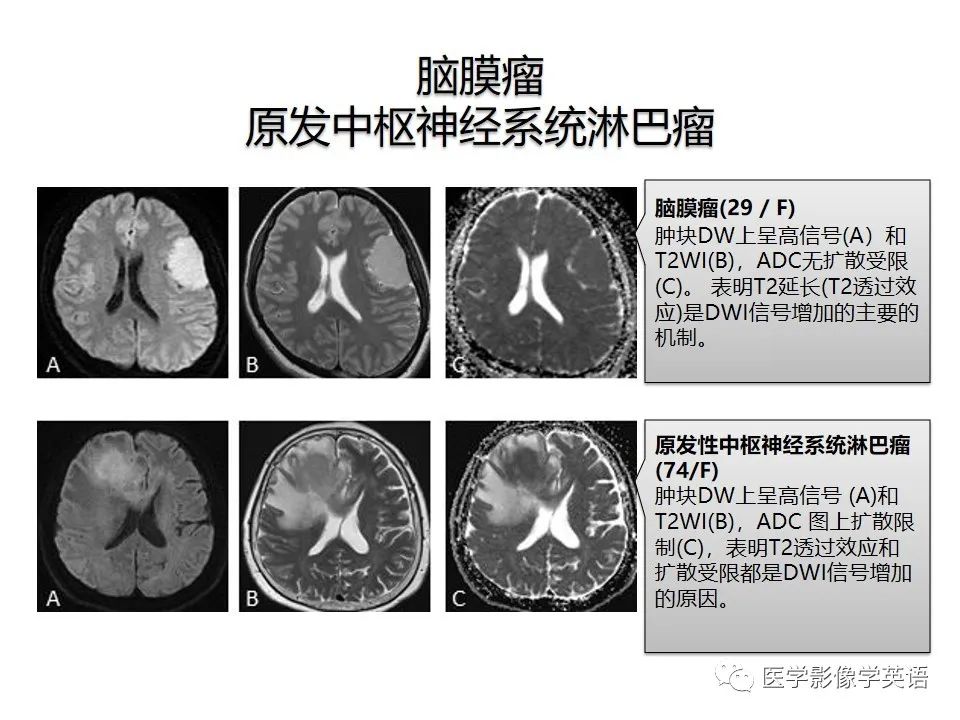 影像PPT - 【PPT】颅内DWI高信号病变：从发现病灶到准确诊断-23