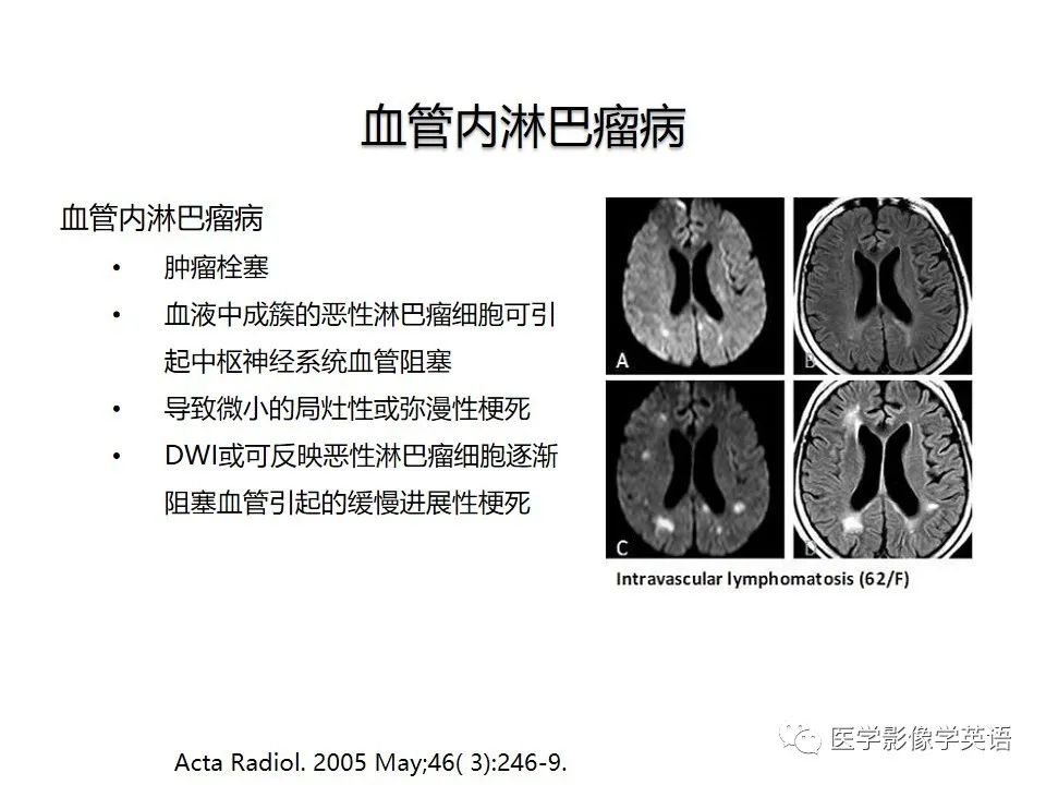 影像PPT - 【PPT】颅内DWI高信号病变：从发现病灶到准确诊断-24