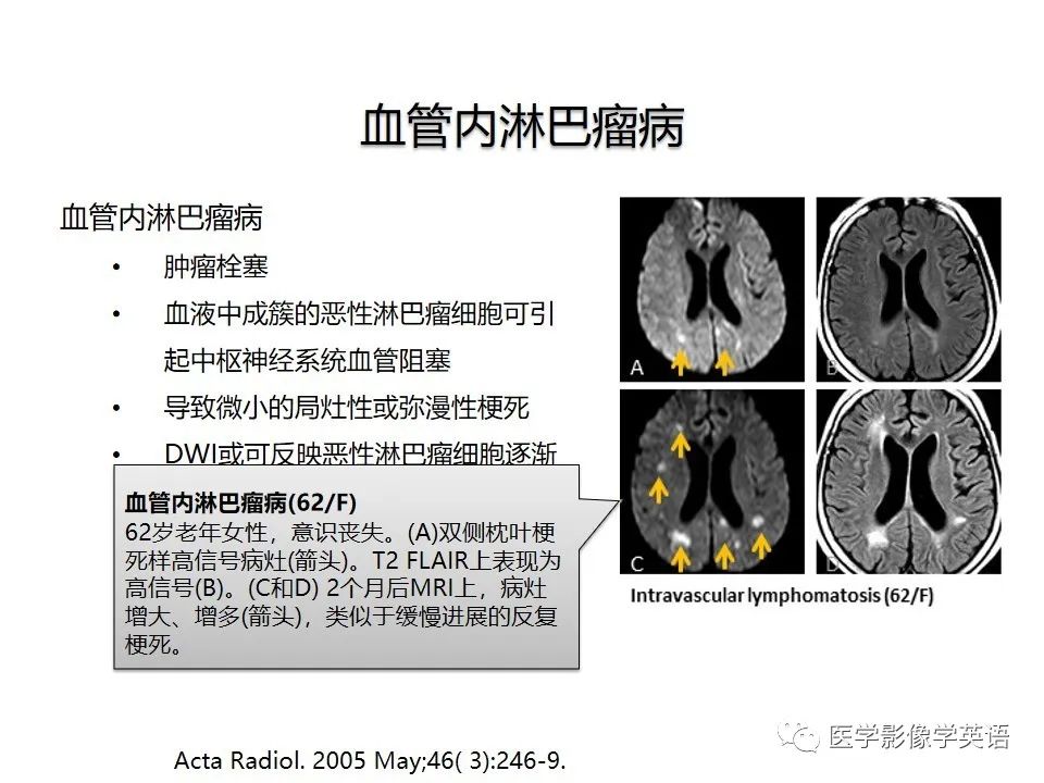 影像PPT - 【PPT】颅内DWI高信号病变：从发现病灶到准确诊断-25