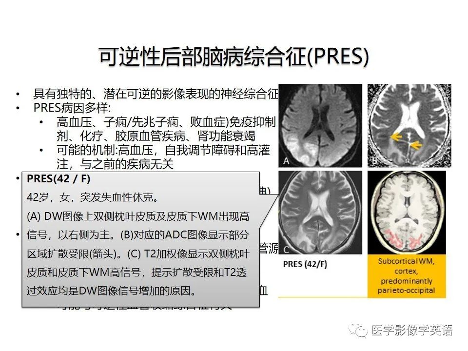 影像PPT - 【PPT】颅内DWI高信号病变：从发现病灶到准确诊断-33