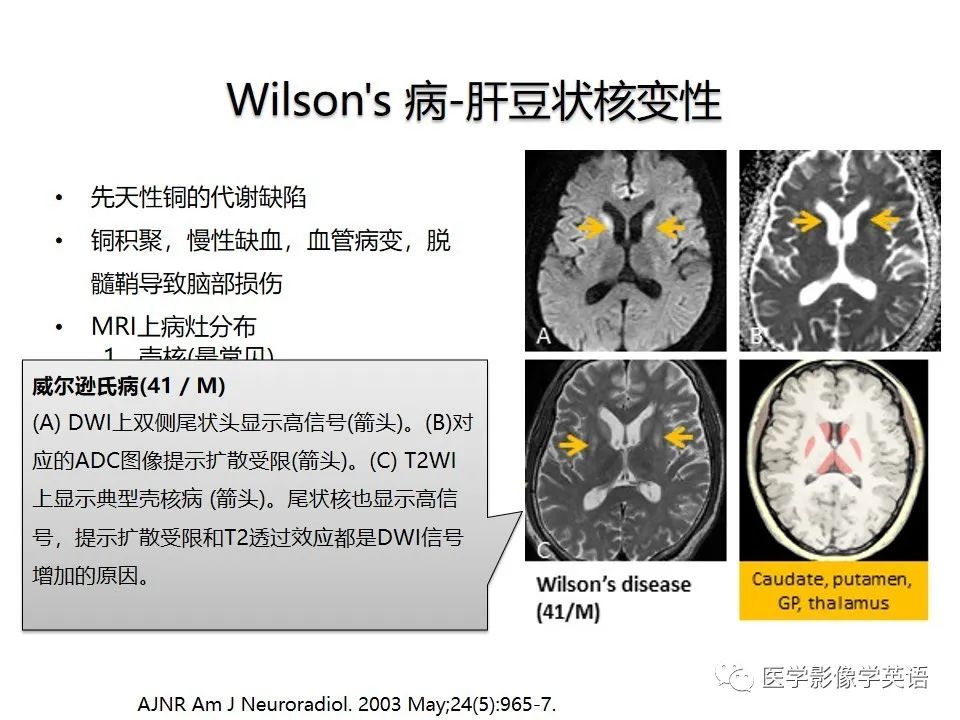 影像PPT - 【PPT】颅内DWI高信号病变：从发现病灶到准确诊断-39