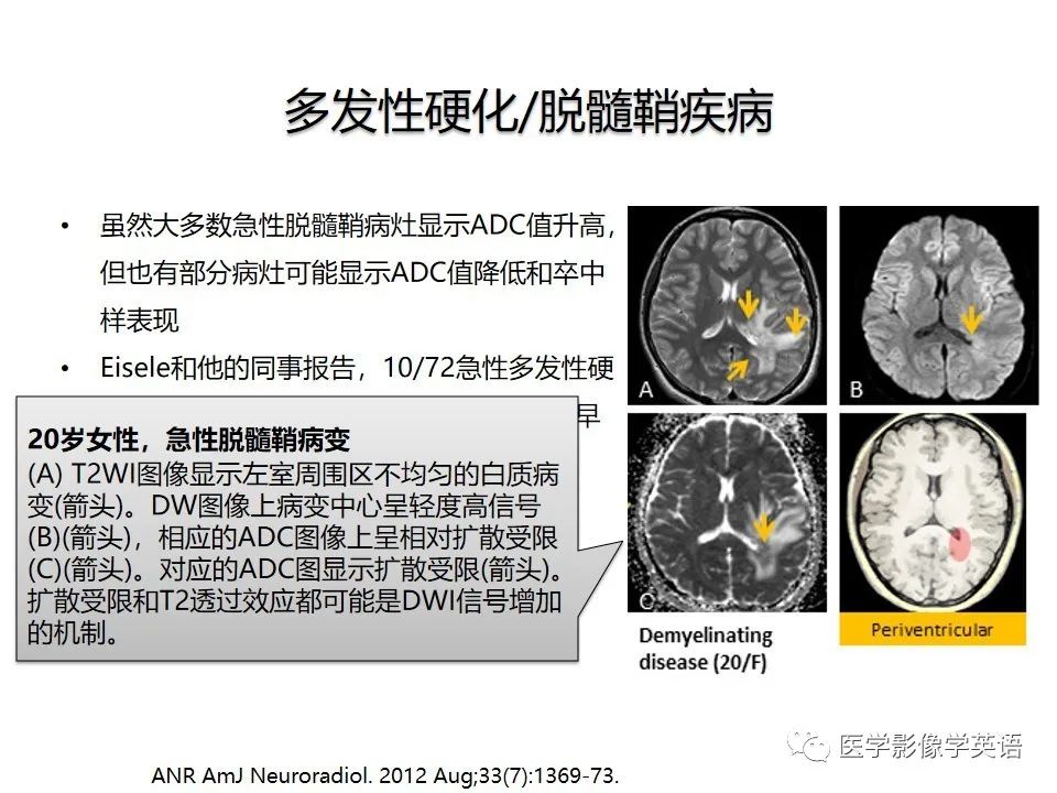 影像PPT - 【PPT】颅内DWI高信号病变：从发现病灶到准确诊断-47