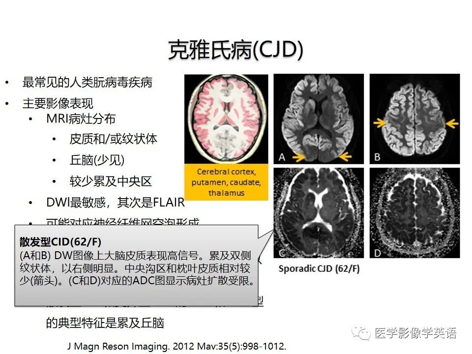 影像PPT - 【PPT】颅内DWI高信号病变：从发现病灶到准确诊断-41
