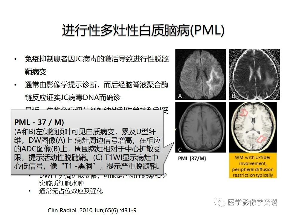 影像PPT - 【PPT】颅内DWI高信号病变：从发现病灶到准确诊断-43