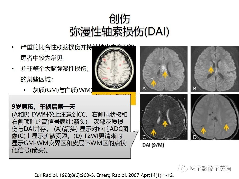 影像PPT - 【PPT】颅内DWI高信号病变：从发现病灶到准确诊断-49