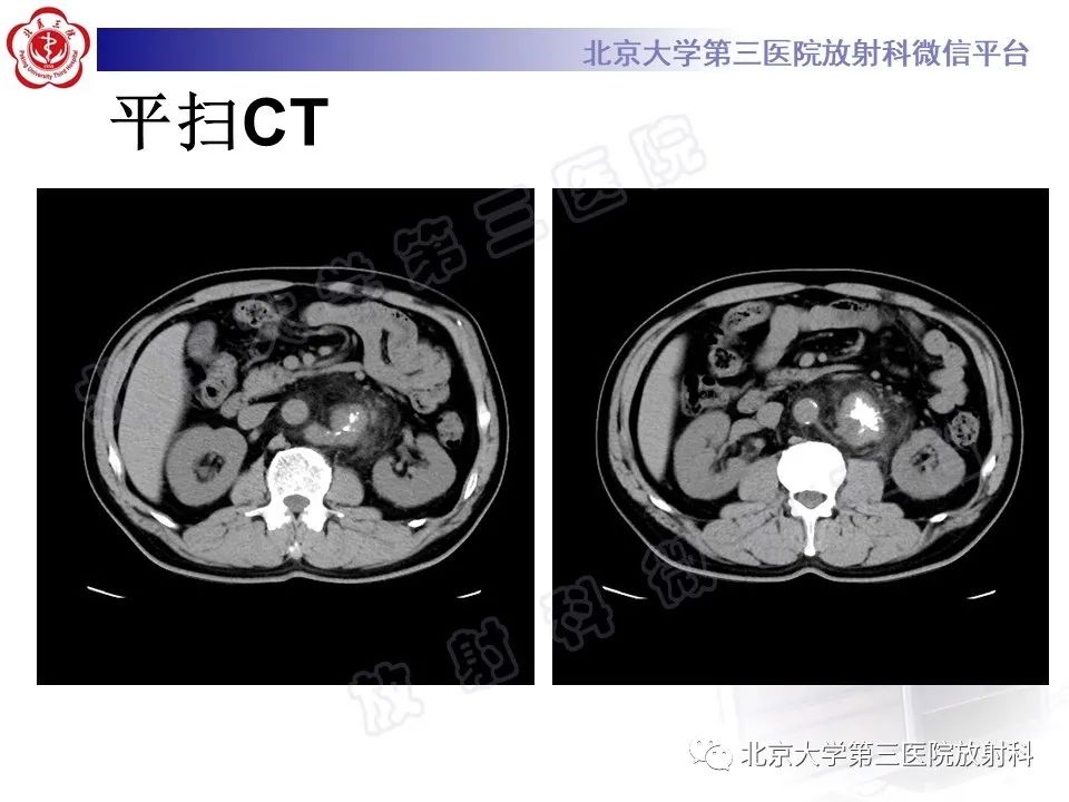 影像PPT - 【PPT】腹膜后单中心型Castleman病-3