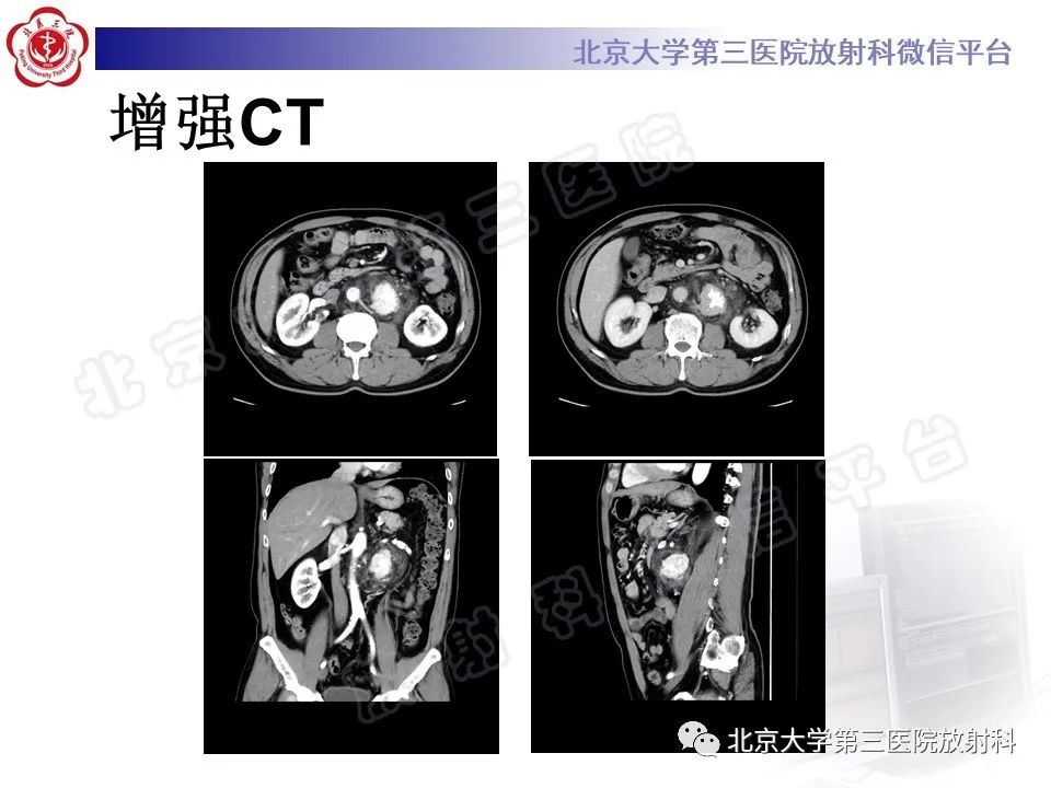 影像PPT - 【PPT】腹膜后单中心型Castleman病-4