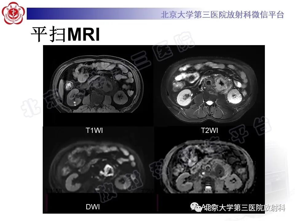 影像PPT - 【PPT】腹膜后单中心型Castleman病-5