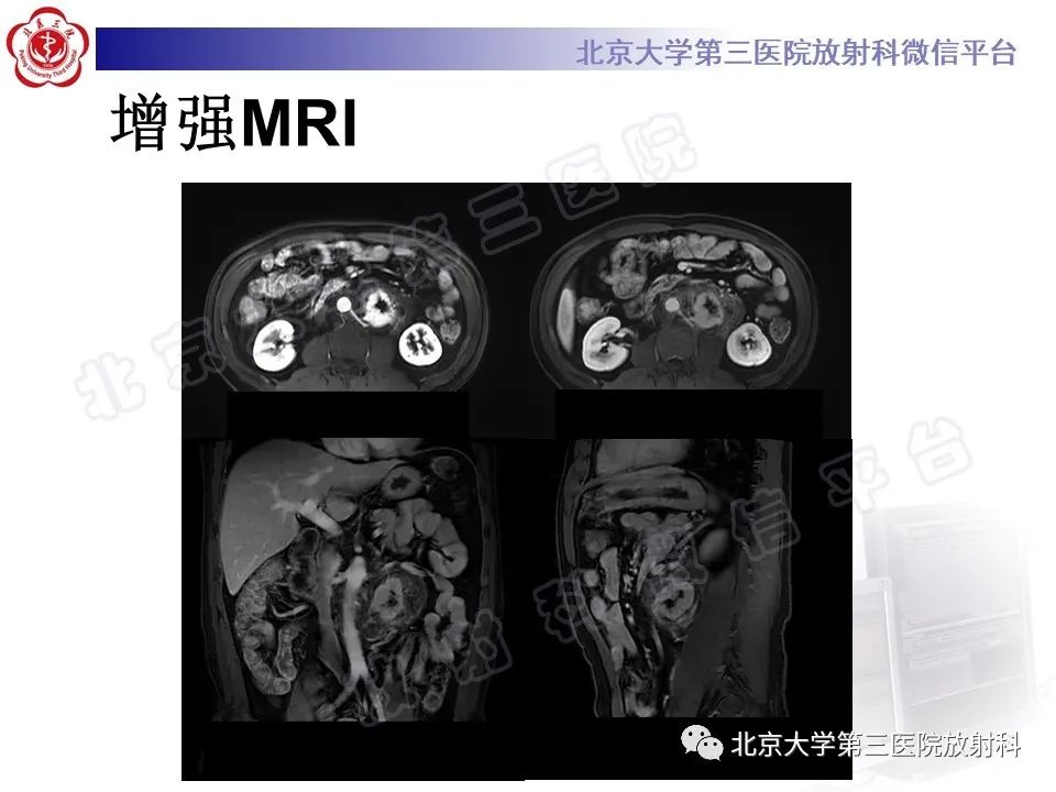 影像PPT - 【PPT】腹膜后单中心型Castleman病-6