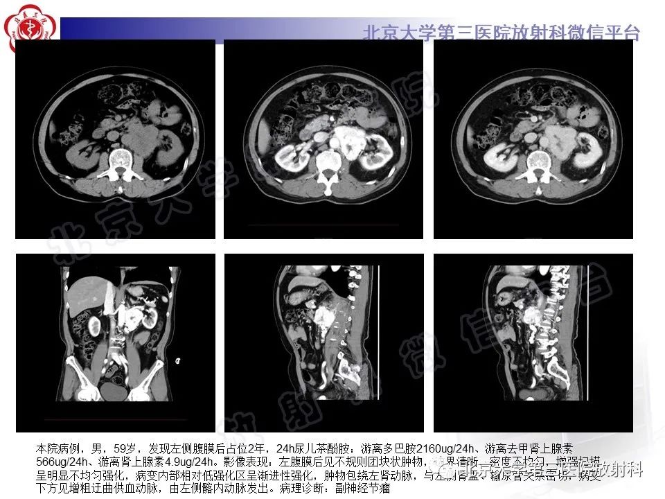 影像PPT - 【PPT】腹膜后单中心型Castleman病-17