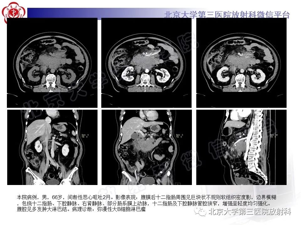 影像PPT - 【PPT】腹膜后单中心型Castleman病-19