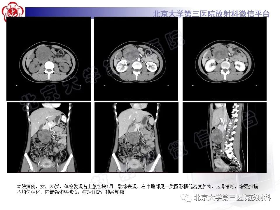 影像PPT - 【PPT】腹膜后单中心型Castleman病-21