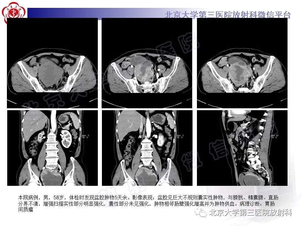 影像PPT - 【PPT】腹膜后单中心型Castleman病-23