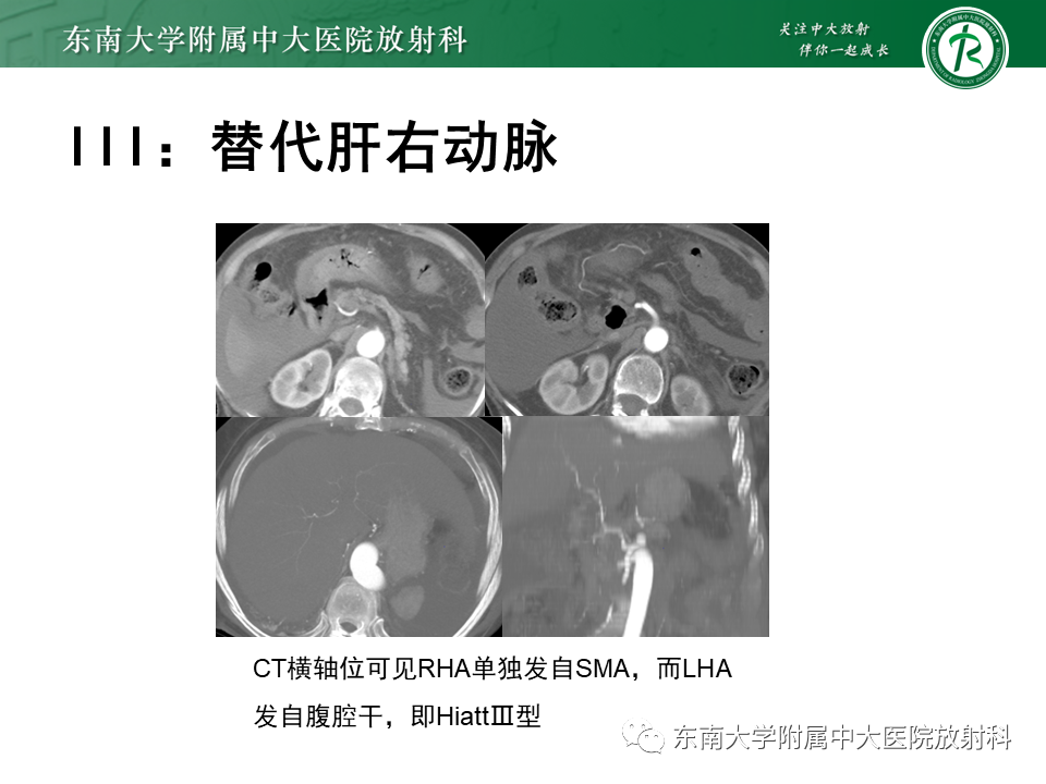 影像PPT - 【PPT】肝动脉变异-20