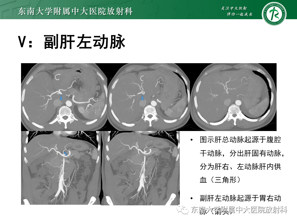影像PPT - 【PPT】肝动脉变异-24
