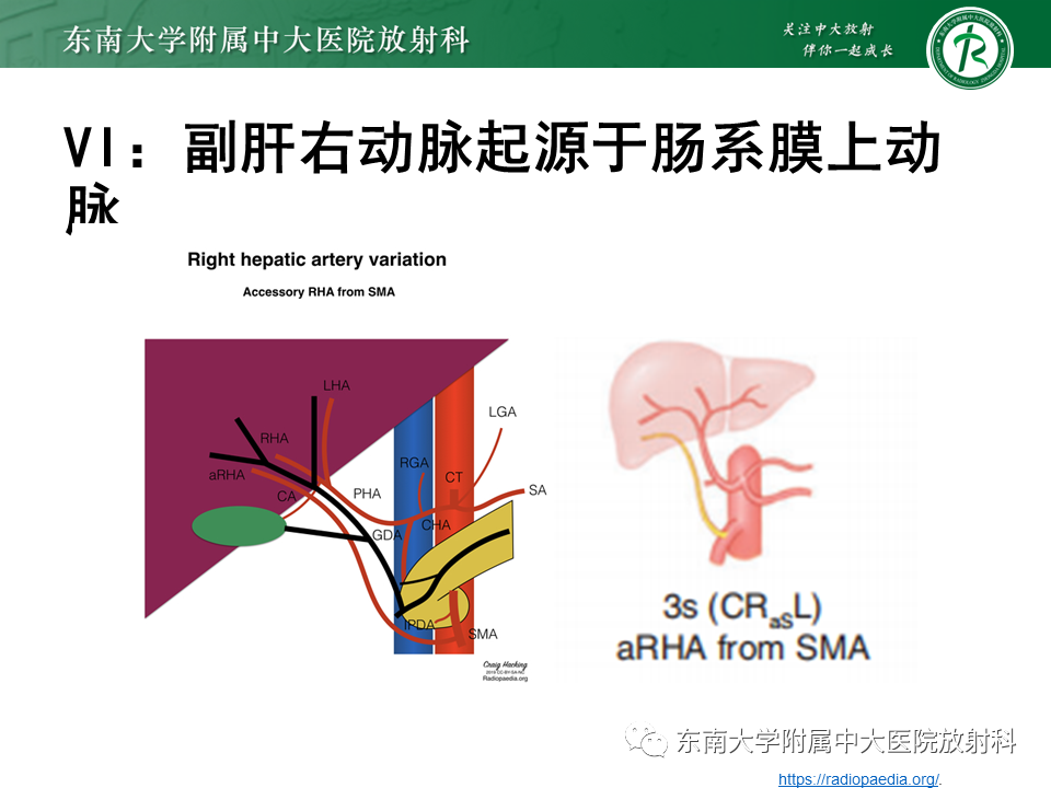 影像PPT - 【PPT】肝动脉变异-26