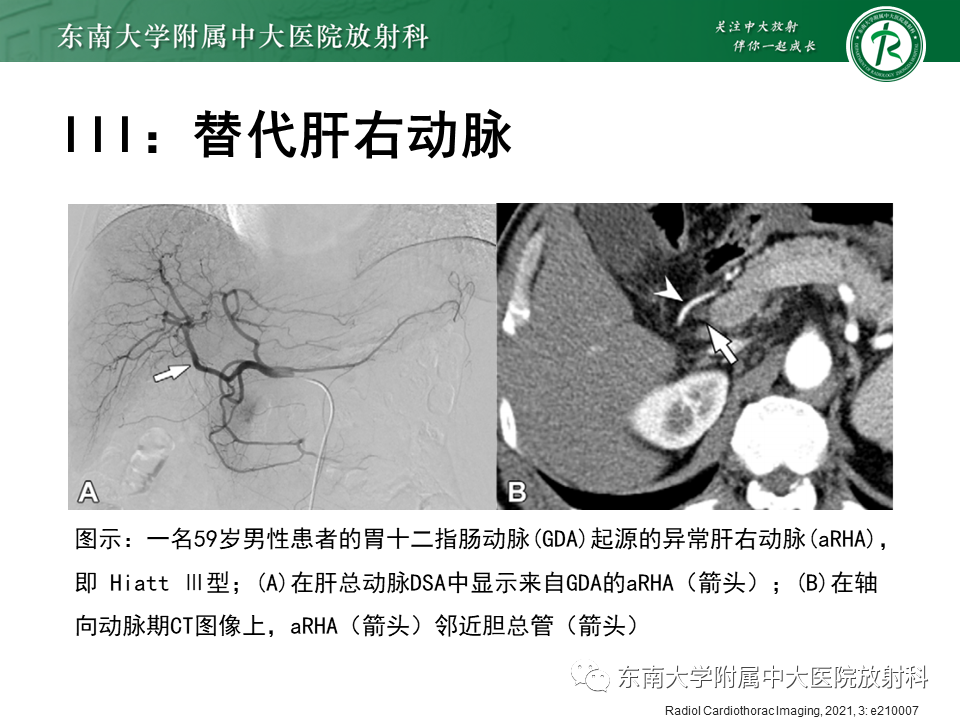 影像PPT - 【PPT】肝动脉变异-21