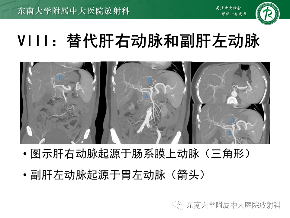影像PPT - 【PPT】肝动脉变异-29