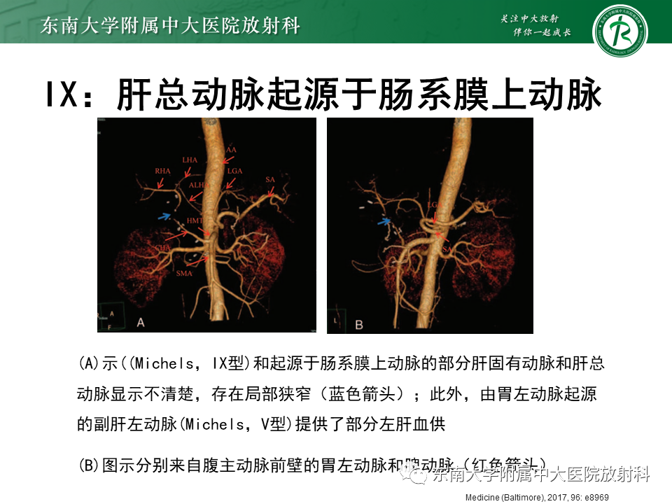 影像PPT - 【PPT】肝动脉变异-32