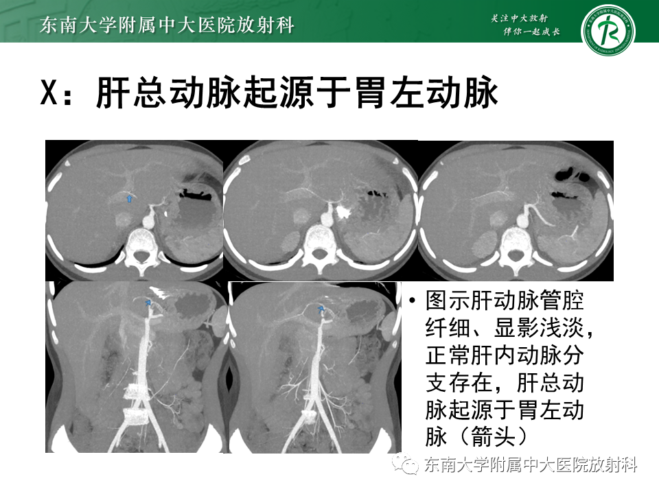 影像PPT - 【PPT】肝动脉变异-34