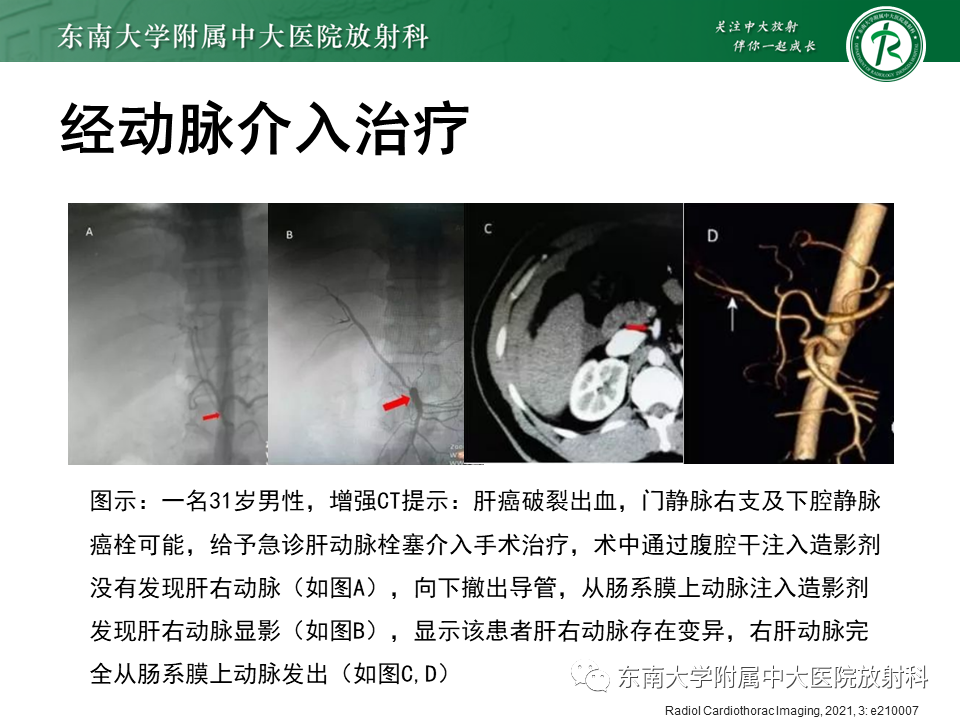 影像PPT - 【PPT】肝动脉变异-40