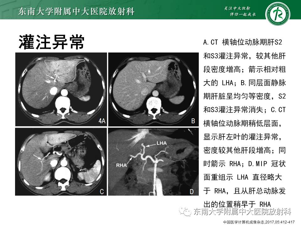 影像PPT - 【PPT】肝动脉变异-41