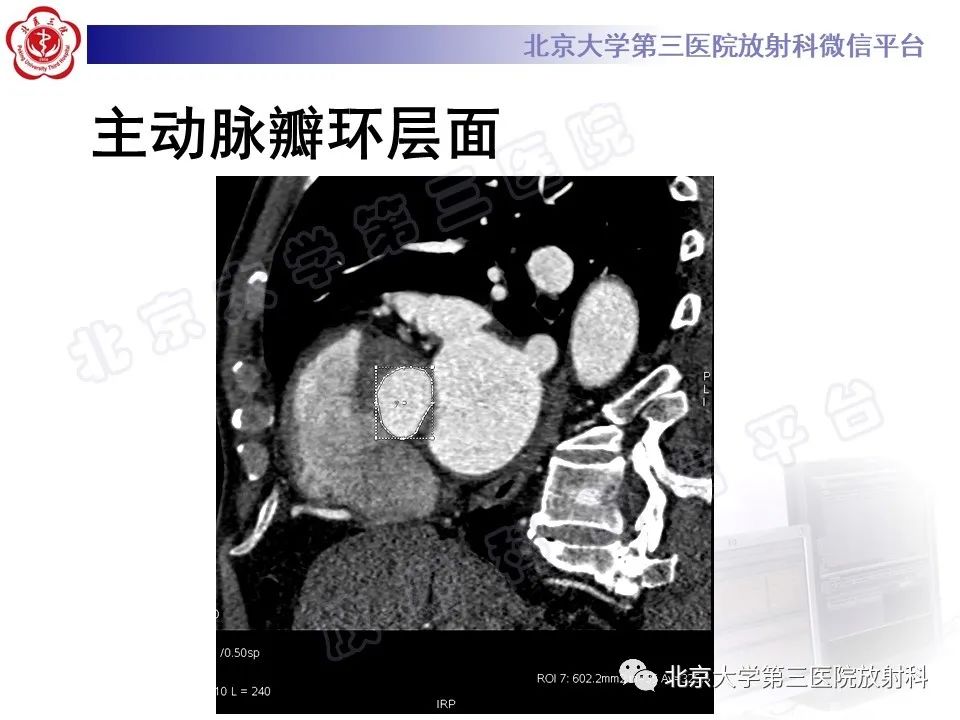影像PPT - 【PPT】经导管主动脉瓣植入/置换术前CT评价-6