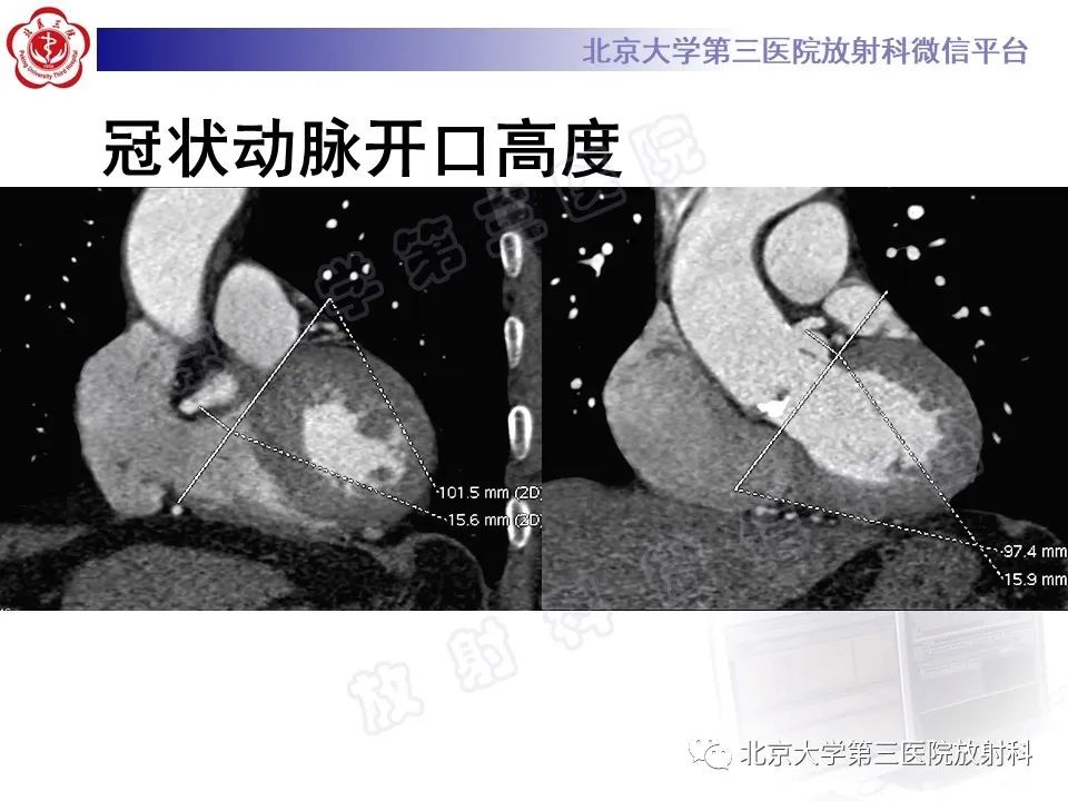 影像PPT - 【PPT】经导管主动脉瓣植入/置换术前CT评价-7