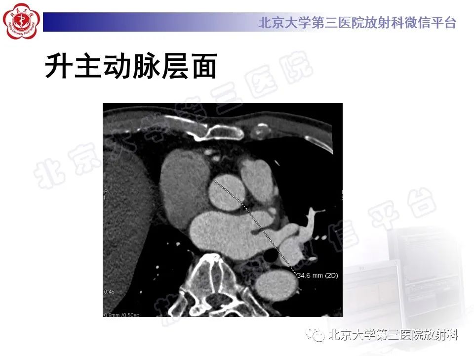 影像PPT - 【PPT】经导管主动脉瓣植入/置换术前CT评价-9