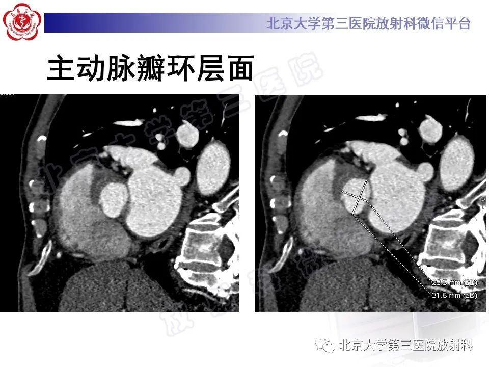 影像PPT - 【PPT】经导管主动脉瓣植入/置换术前CT评价-5