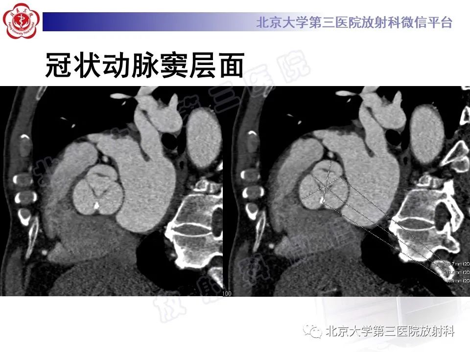影像PPT - 【PPT】经导管主动脉瓣植入/置换术前CT评价-8