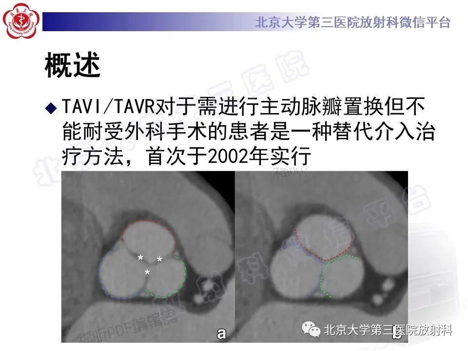 影像PPT - 【PPT】经导管主动脉瓣植入/置换术前CT评价-11