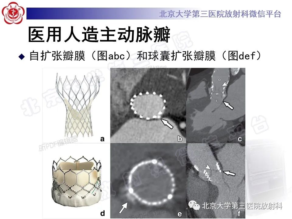影像PPT - 【PPT】经导管主动脉瓣植入/置换术前CT评价-12