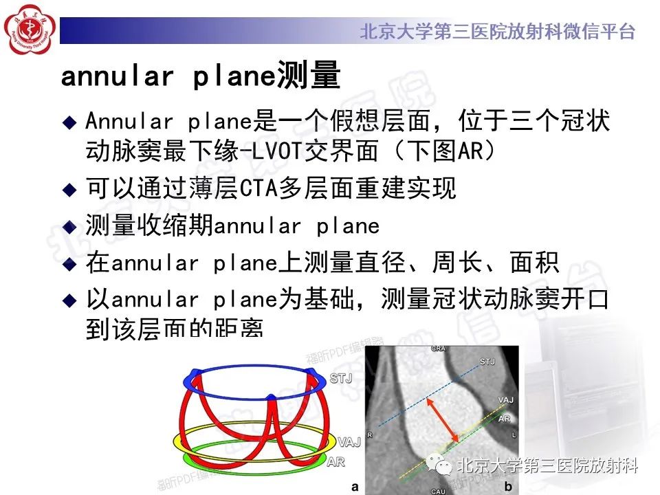 影像PPT - 【PPT】经导管主动脉瓣植入/置换术前CT评价-16