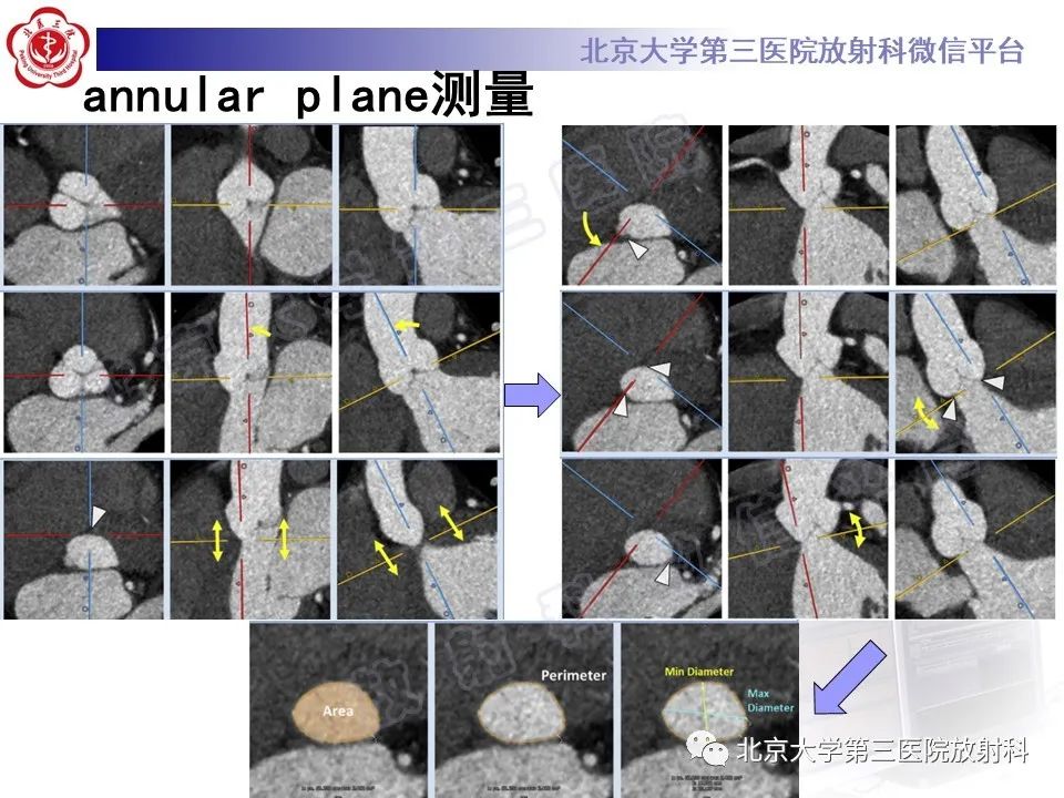 影像PPT - 【PPT】经导管主动脉瓣植入/置换术前CT评价-17