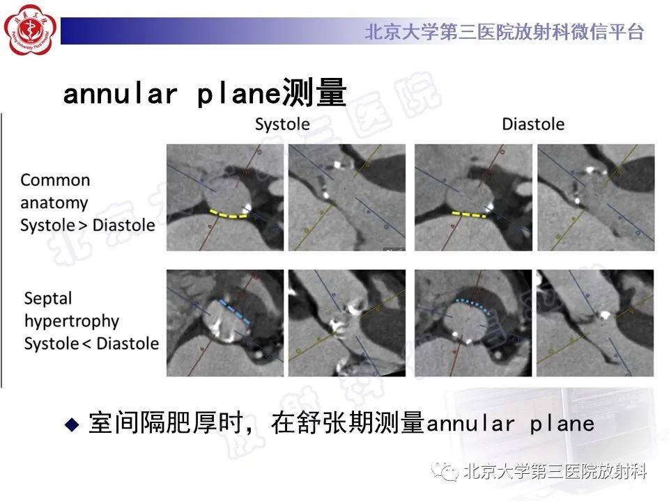 影像PPT - 【PPT】经导管主动脉瓣植入/置换术前CT评价-18