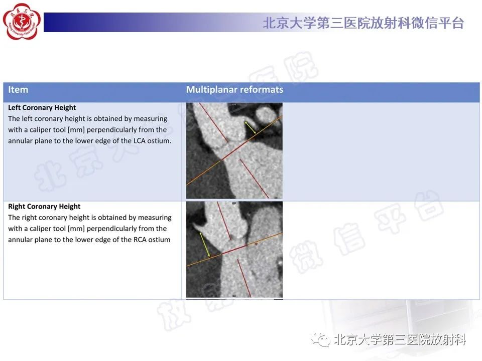 影像PPT - 【PPT】经导管主动脉瓣植入/置换术前CT评价-20