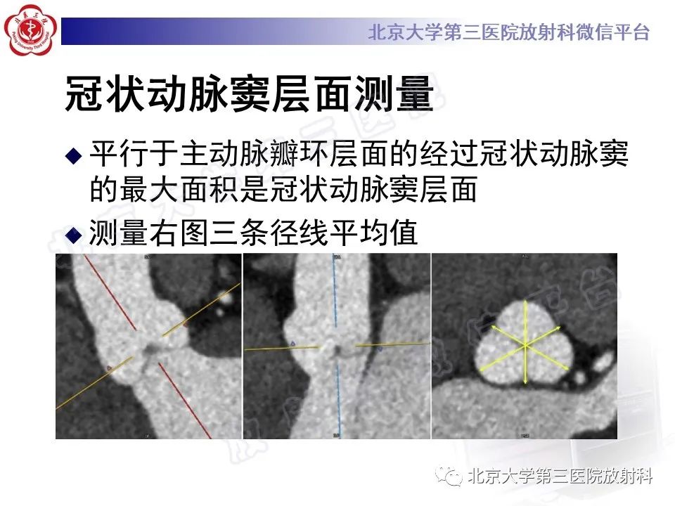 影像PPT - 【PPT】经导管主动脉瓣植入/置换术前CT评价-21