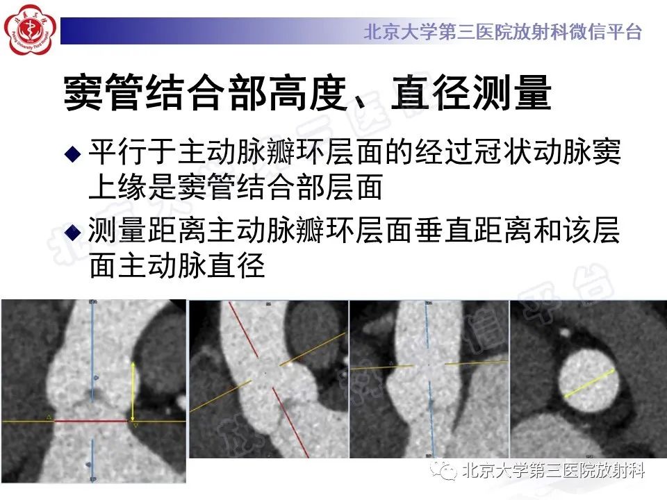 影像PPT - 【PPT】经导管主动脉瓣植入/置换术前CT评价-22