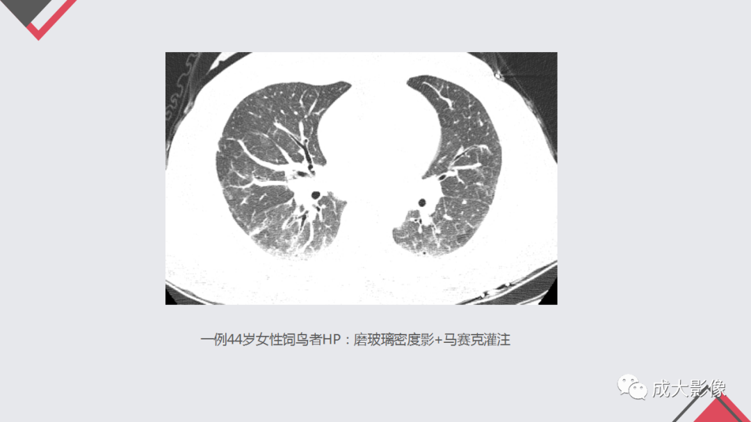 影像PPT - 【PPT】过敏性肺炎-12