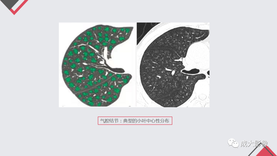 影像PPT - 【PPT】过敏性肺炎-11