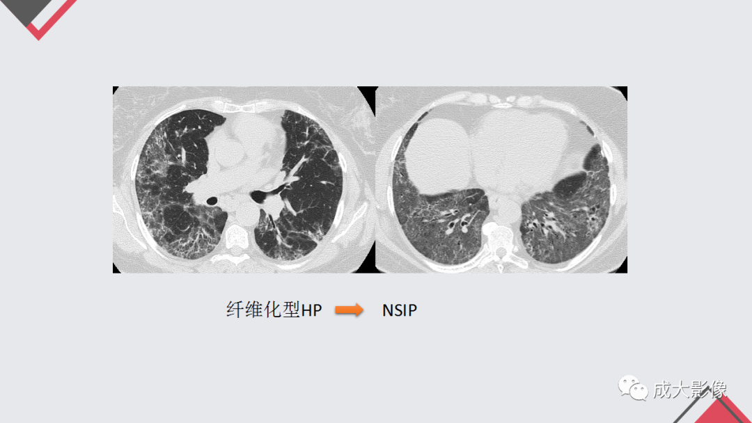 影像PPT - 【PPT】过敏性肺炎-18
