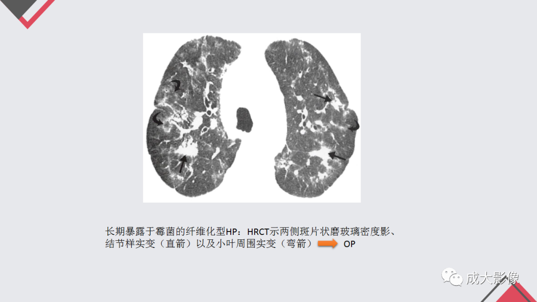 影像PPT - 【PPT】过敏性肺炎-19