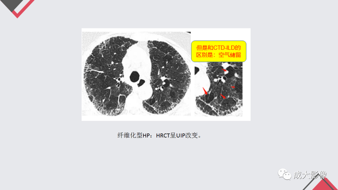 影像PPT - 【PPT】过敏性肺炎-22