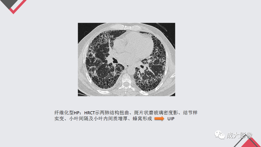 影像PPT - 【PPT】过敏性肺炎-21