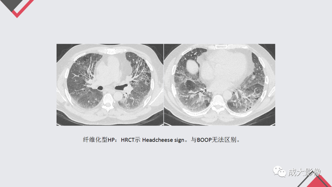 影像PPT - 【PPT】过敏性肺炎-20