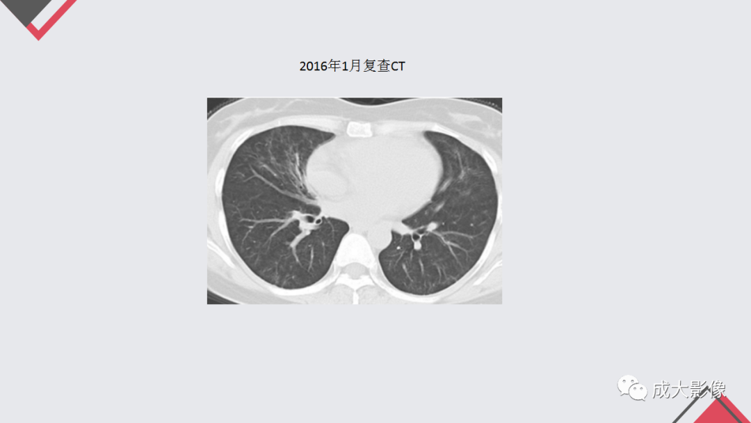 影像PPT - 【PPT】过敏性肺炎-29