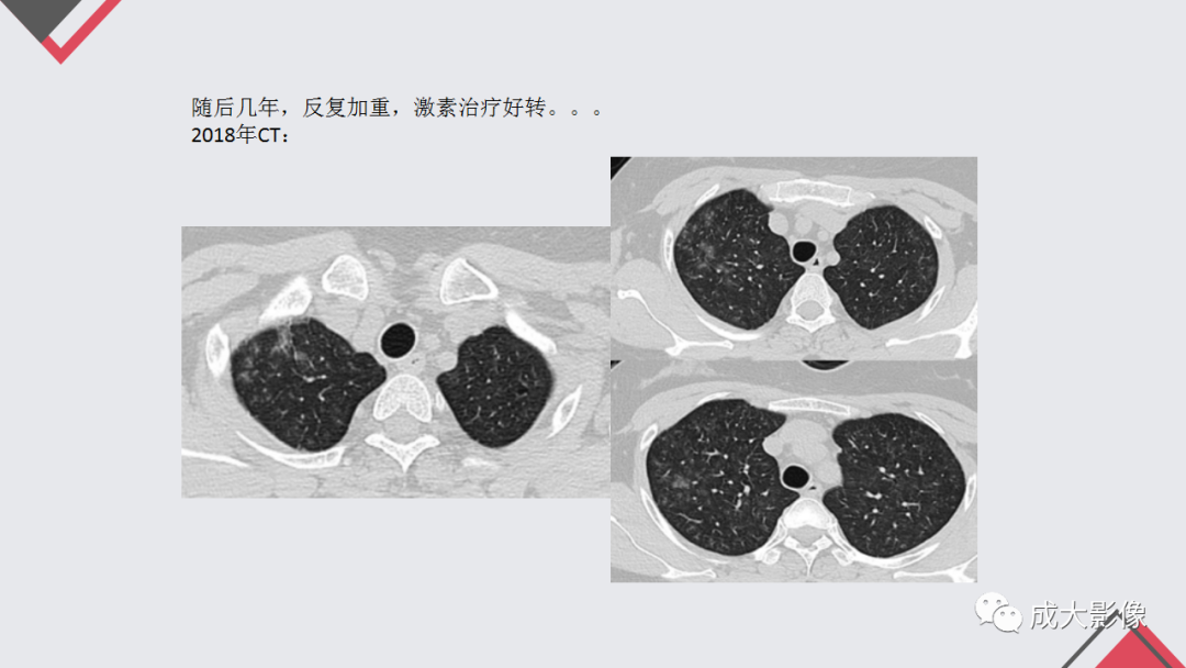 影像PPT - 【PPT】过敏性肺炎-30