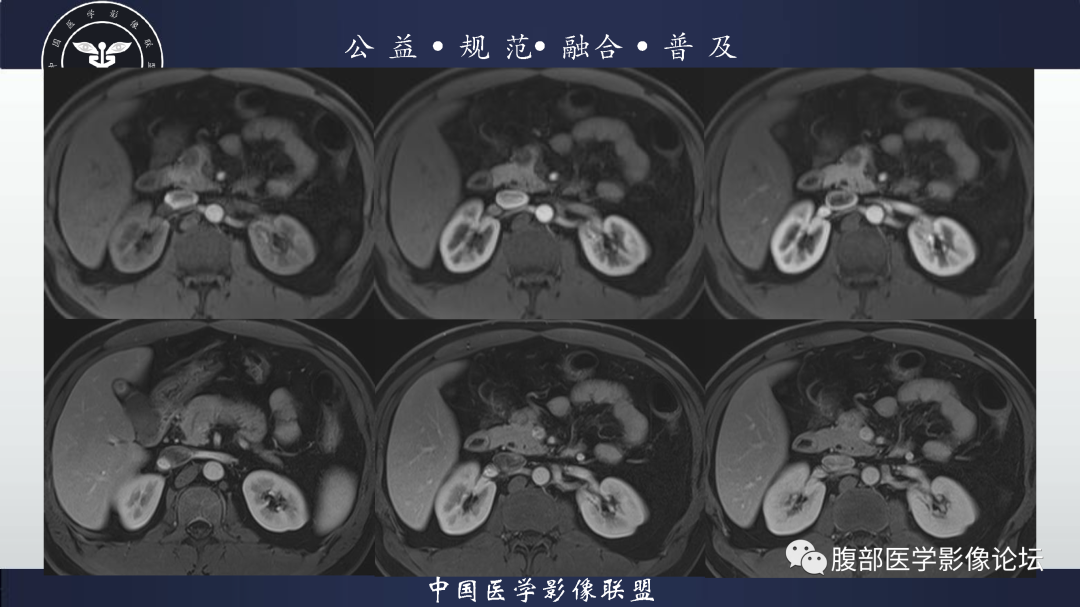 影像PPT - 【病例】胰腺高分化导管腺癌1例CT及MR影像-6