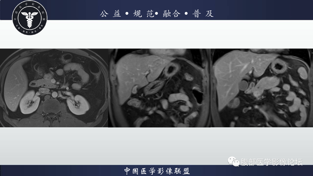 影像PPT - 【病例】胰腺高分化导管腺癌1例CT及MR影像-7